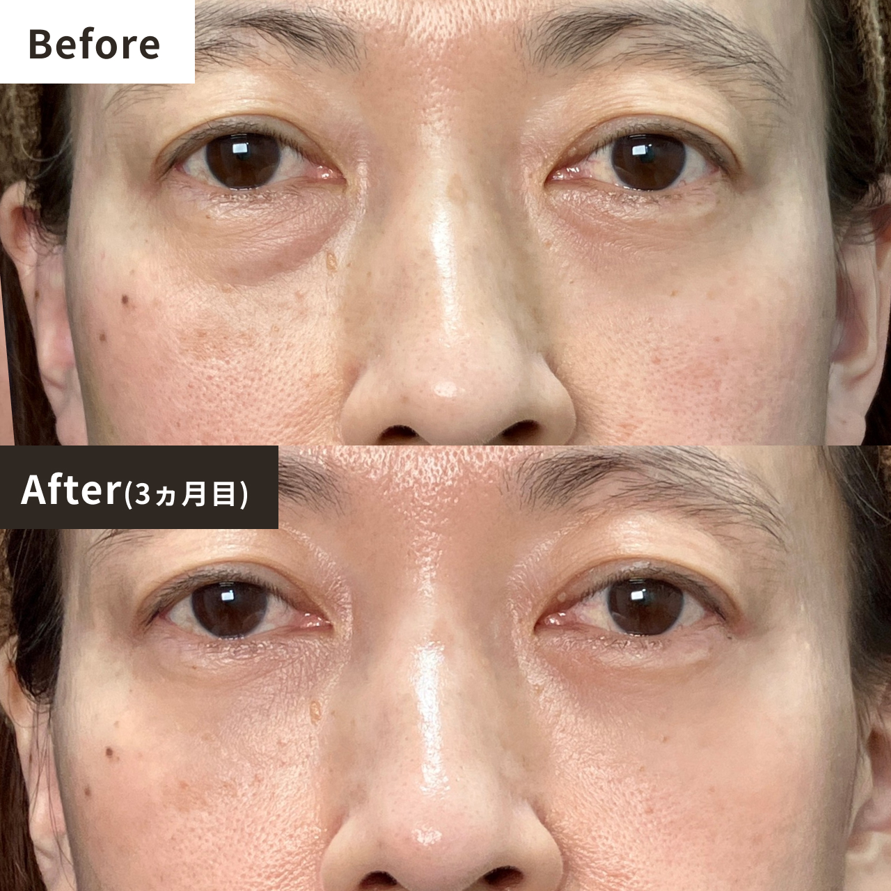 Before After（3ヶ月目）