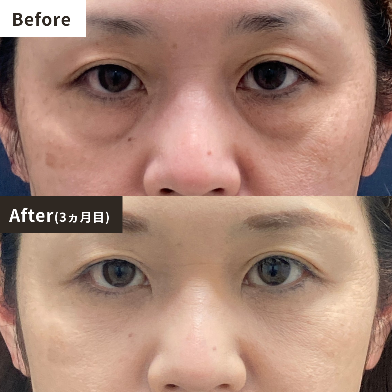 Before After（3ヶ月目）