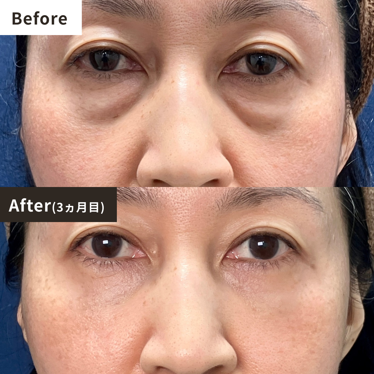 Before After（3ヶ月目）