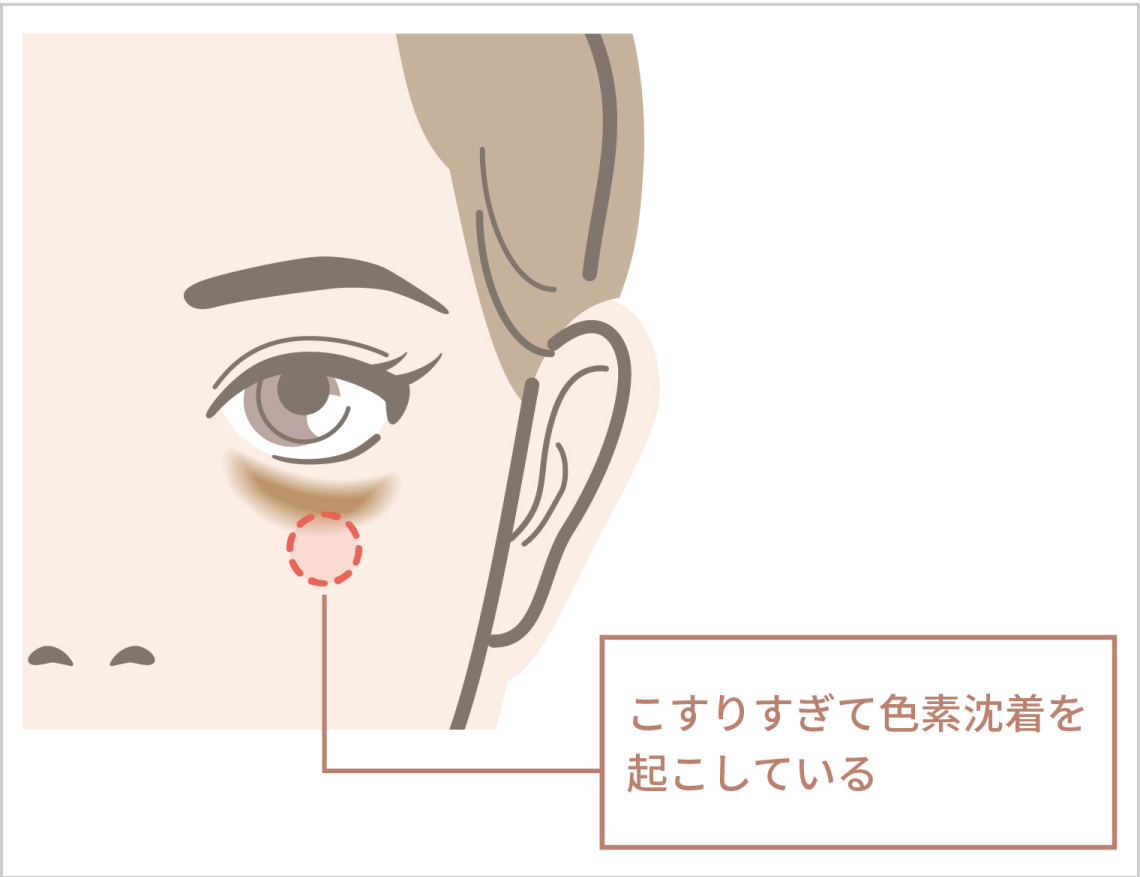 こすりすぎて色素沈着を起こしている