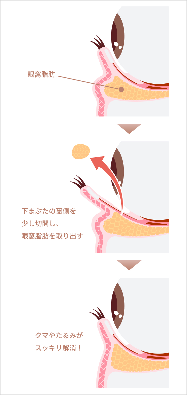 眼窩脂肪　下まぶたを切除し、眼窩脂肪を取り出す　クマやたるみがスッキリ解消！