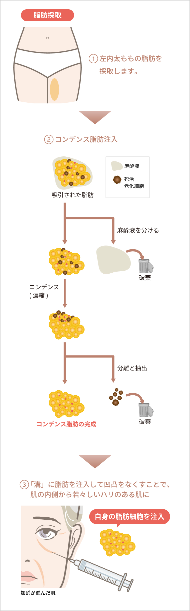 ①左内太ももの脂肪を採取します。　②コンデンス脂肪注入　③「溝」に脂肪を注入して凹凸をなくすことで、肌の内側から若々しいハリのある肌に