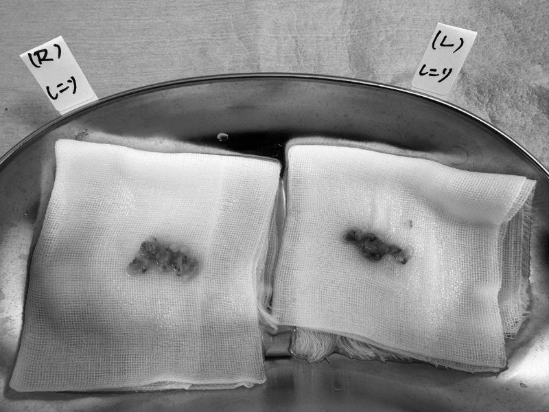 手術中に発見された過去の注入物がしこりになったもの