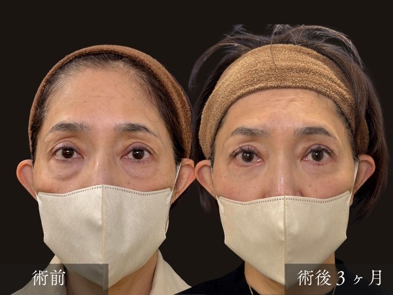 表ハムラの症例写真